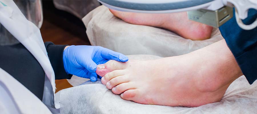 Calluses Specialist  Foot Callus Removal in Clifton and Wayne, NJ