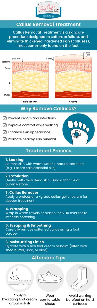 Calluses can cause discomfort and affect the appearance of your feet, but with the right treatment, they can be easily managed. Wendell Family Medicine offers professional callus removal treatments tailored to your needs. Dr. Anna Marie Duncan, DO, and Dr. Lisa A. Bledsoe, MD, provide expert care to help you maintain smooth, healthy feet. For more information, contact us or book an appointment online. We are located at 2839 Wendell Blvd, Suite 100, Wendell, NC 27591. Calluses can cause discomfort and affect the appearance of your feet, but with the right treatment, they can be easily managed. Wendell Family Medicine offers professional callus removal treatments tailored to your needs. Dr. Anna Marie Duncan, DO, and Dr. Lisa A. Bledsoe, MD, provide expert care to help you maintain smooth, healthy feet. For more information, contact us or book an appointment online. We are located at 2839 Wendell Blvd, Suite 100, Wendell, NC 27591.
