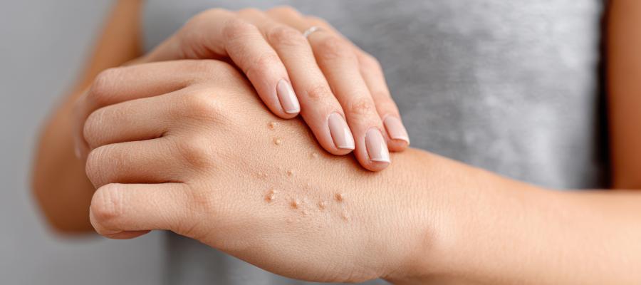 Wart vs Skin Tag: Causes, Symptoms, and Treatment Options | Wendell Family Medicine in Wendell, NC